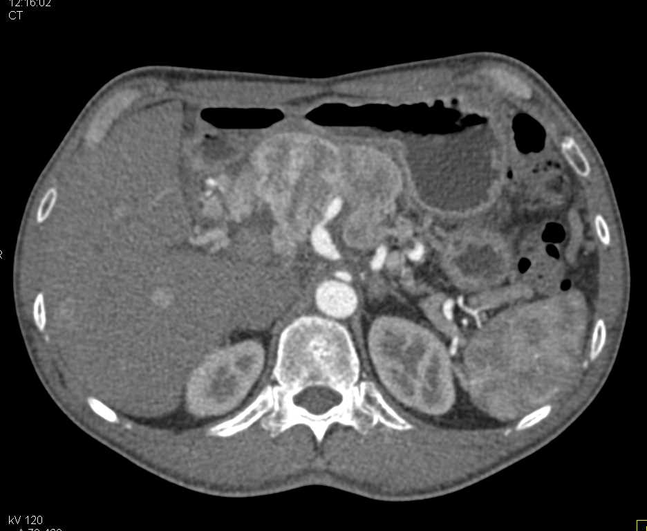 Pancreatic Neuroendocrine Tumor with Liver Metastases - CTisus CT Scan