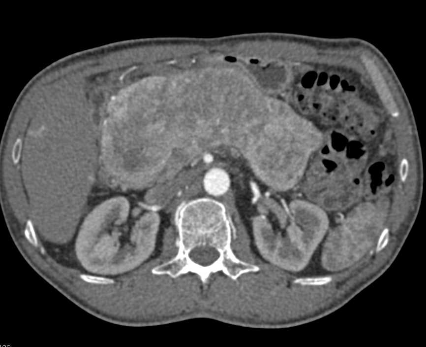 Pancreatic Neuroendocrine Tumor with Liver Metastases - CTisus CT Scan