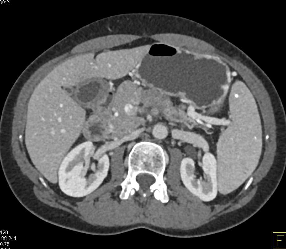 Adenocarcinoma of the Pancreas Invades the Portal Vein - CTisus CT Scan