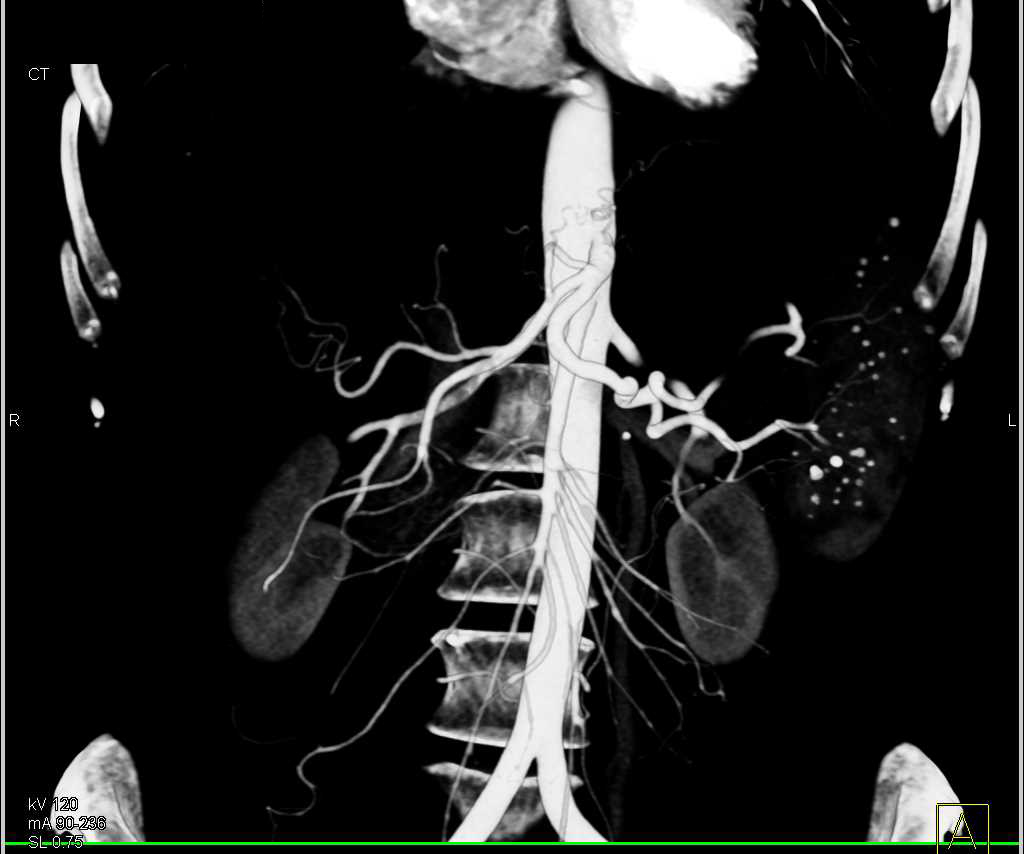 Adenocarcinoma of the Pancreas Invades the Portal Vein - CTisus CT Scan