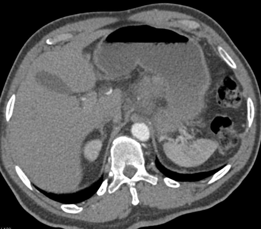 Lymphoma with Infiltration of the Mesentery and the Pancreas - CTisus CT Scan