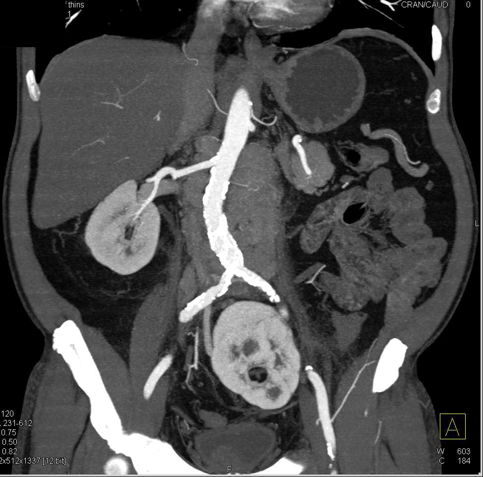 Lymphoma with Extensive Adenopathy Involves the Pancreas - CTisus CT Scan