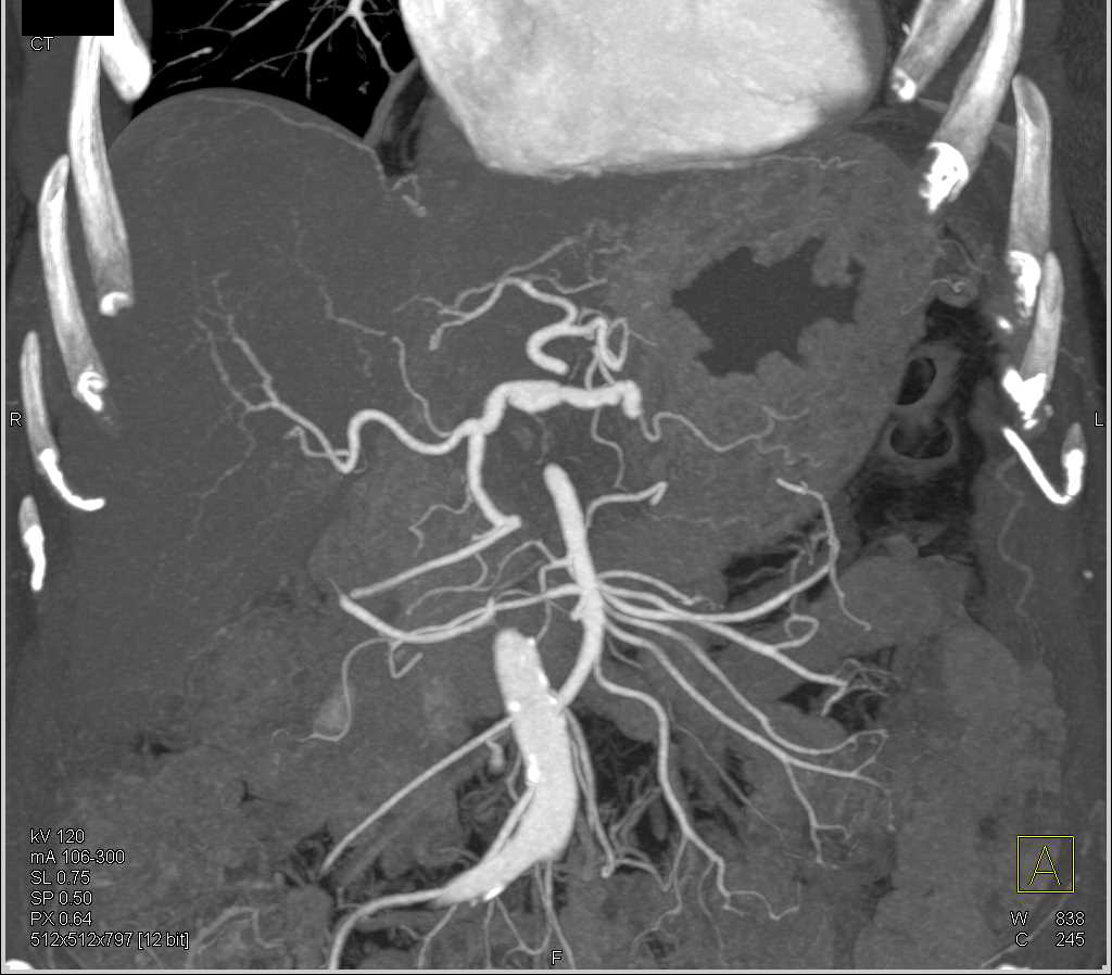 Pancreatic Cancer with Splenic Vein Occlusion - CTisus CT Scan