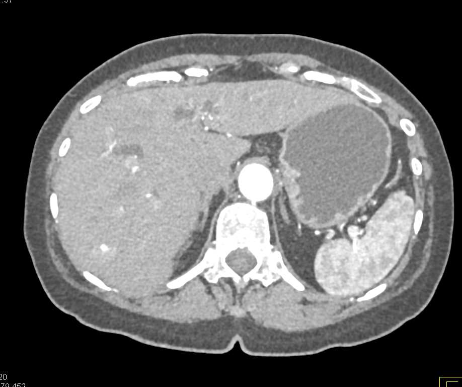 Metastatic Melanoma to the Head of the Pancreas - CTisus CT Scan