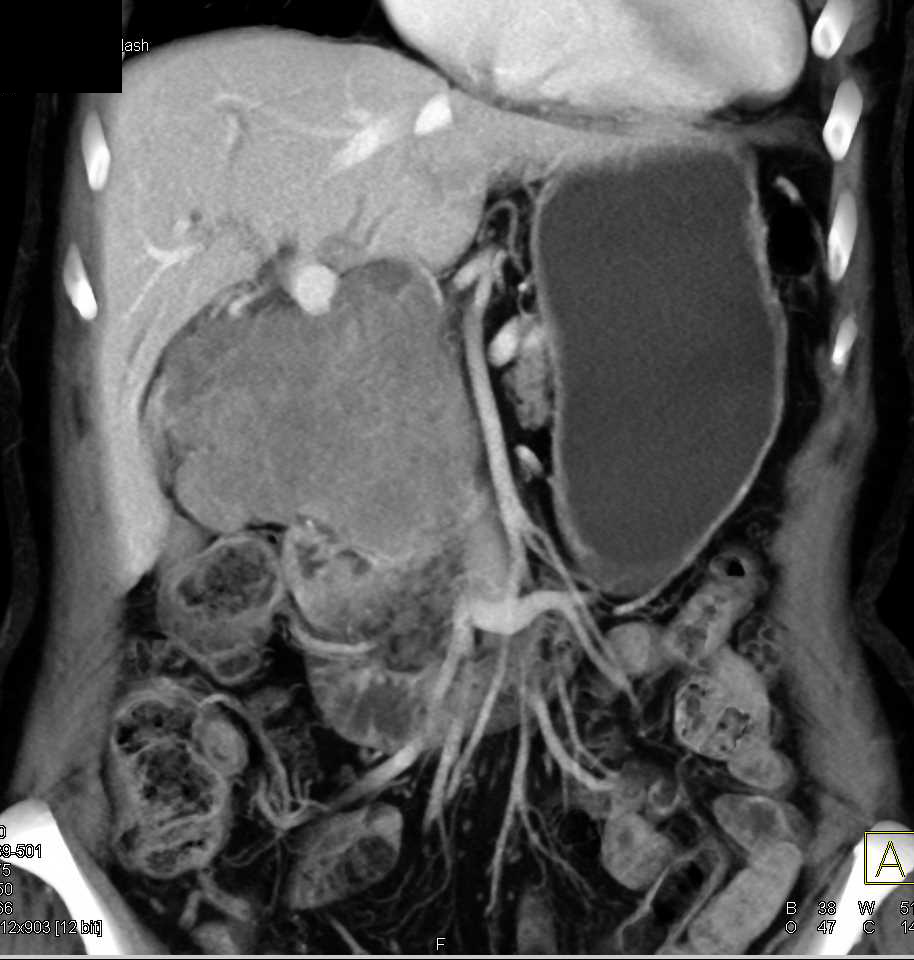 Metastatic Melanoma to the Head of the Pancreas Simulates a Pancreatic Mass - CTisus CT Scan