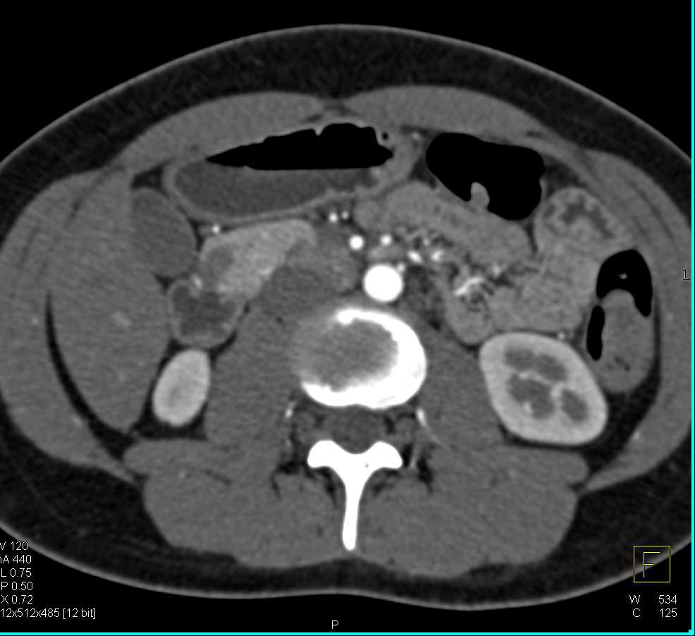 Intraductal Papillary Mucinous Neoplasm (IPMN) in the Head of the Pancreas - CTisus CT Scan