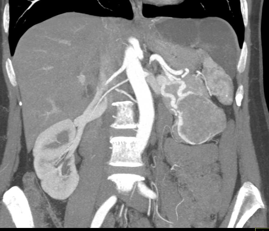 Serous Cystadenoma off the Tail of the Pancreas - CTisus CT Scan