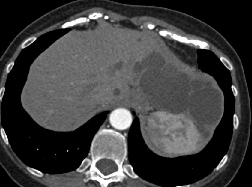 Serous Cystadenoma off the Tail of the Pancreas - CTisus CT Scan