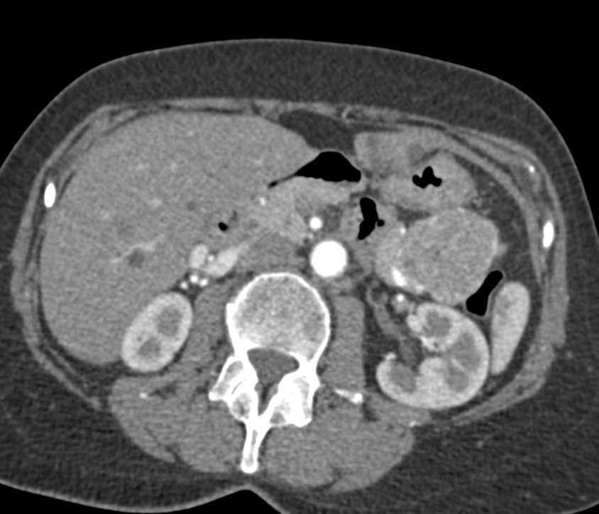 Serous Cystadenoma off the Tail of the Pancreas - CTisus CT Scan