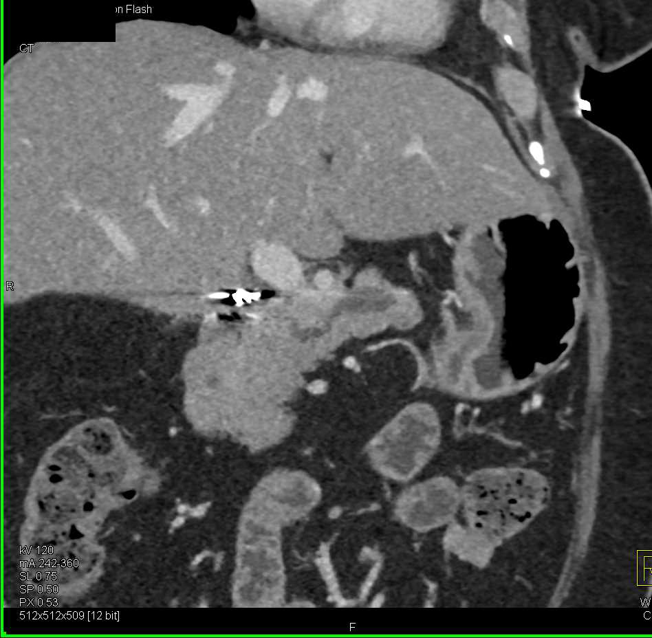 Main Duct Intraductal Papillary Mucinous Neoplasm (IPMN) - CTisus CT Scan