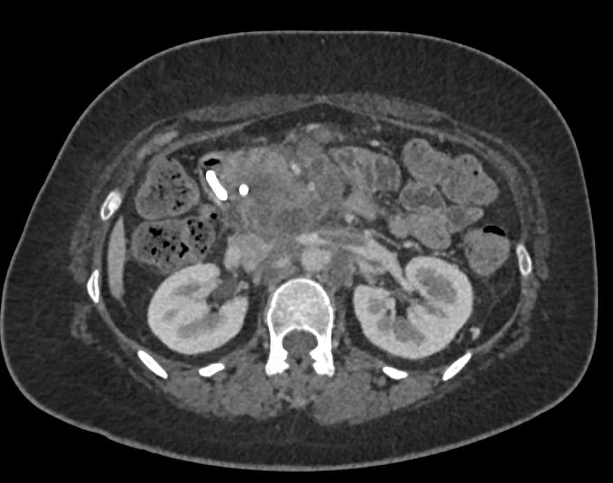 Lymphoma Infiltrates the Pancreas - CTisus CT Scan