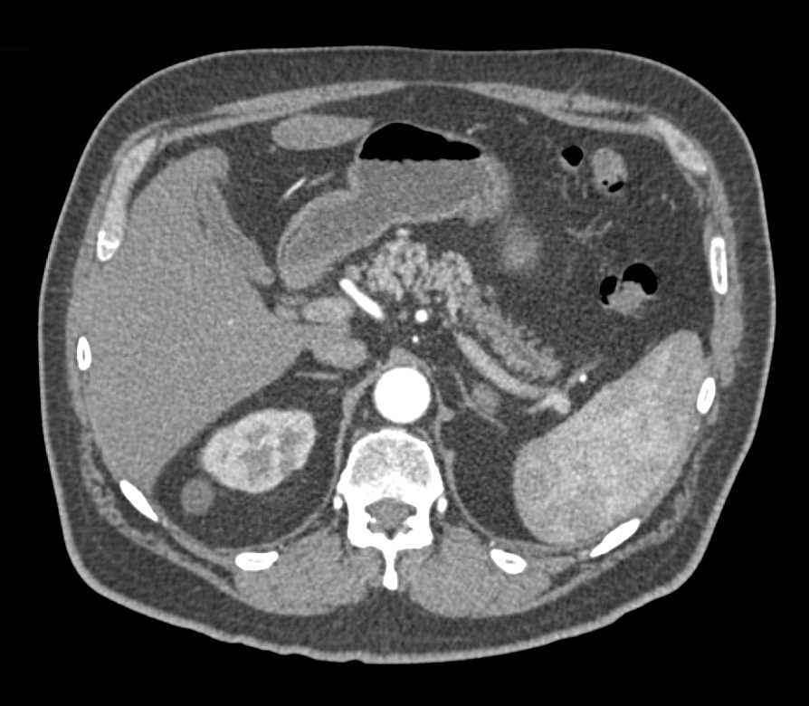 Subtle Carcinoma at Junction of Body and Tail of the Pancreas - CTisus CT Scan