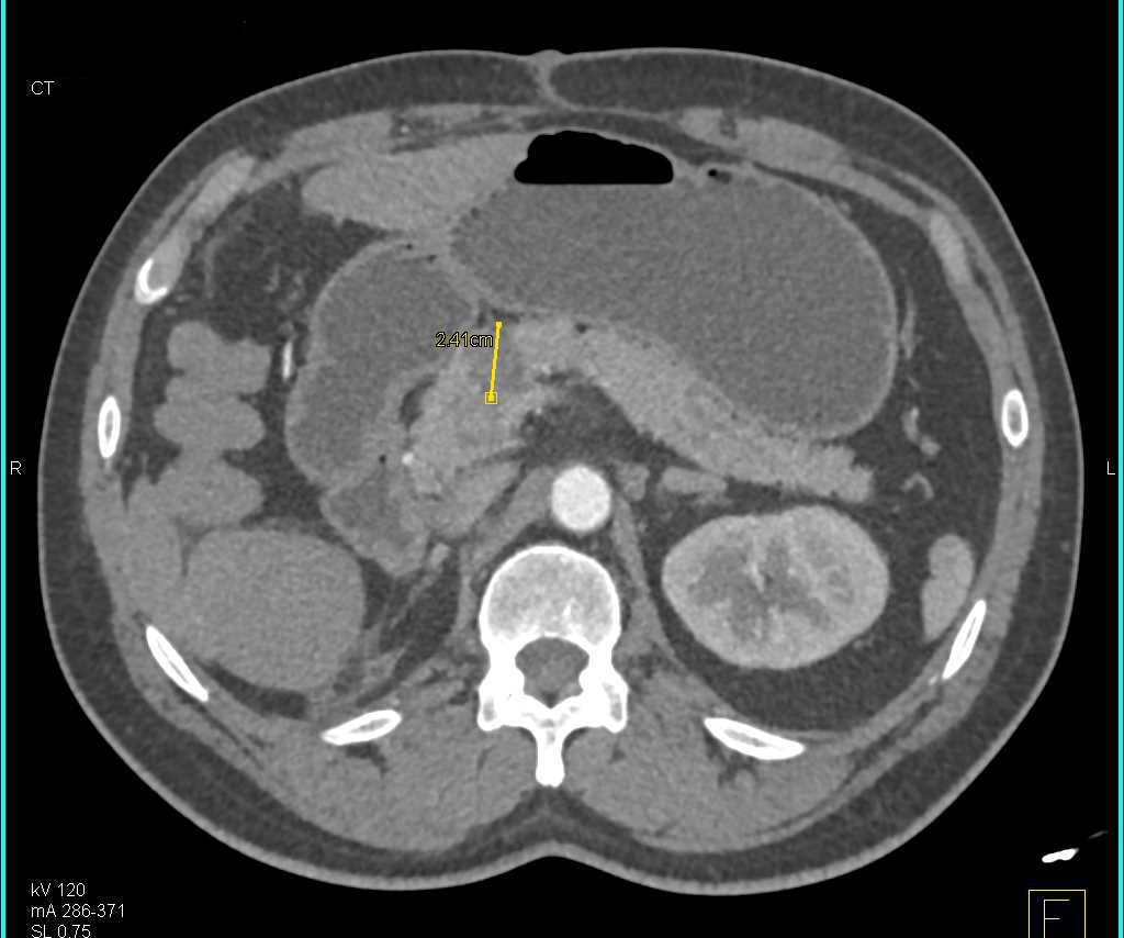 Serous Cystadenoma in Pancreatic Neck - CTisus CT Scan