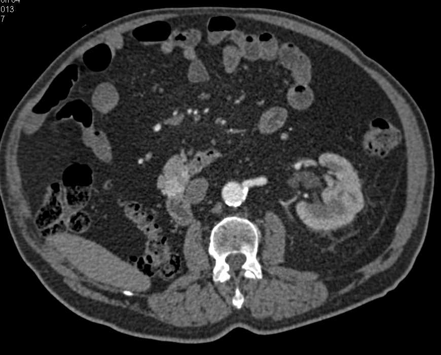 Metastatic Renal Cell Carcinoma to the Head of the Pancreas - CTisus CT Scan