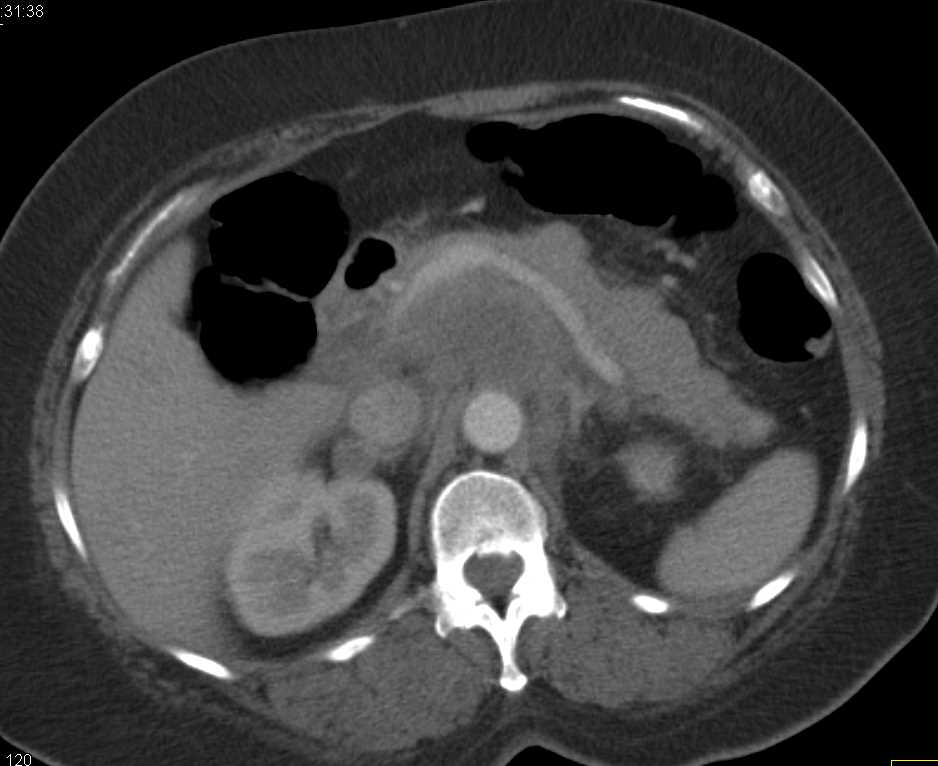 Lymphoma Infiltrating the Pancreas - CTisus CT Scan