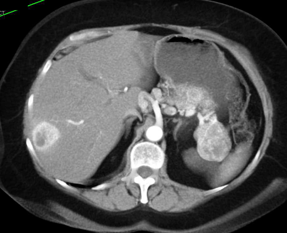 Neuroendocrine Tumor of the Pancreas with Liver Metastases - CTisus CT Scan