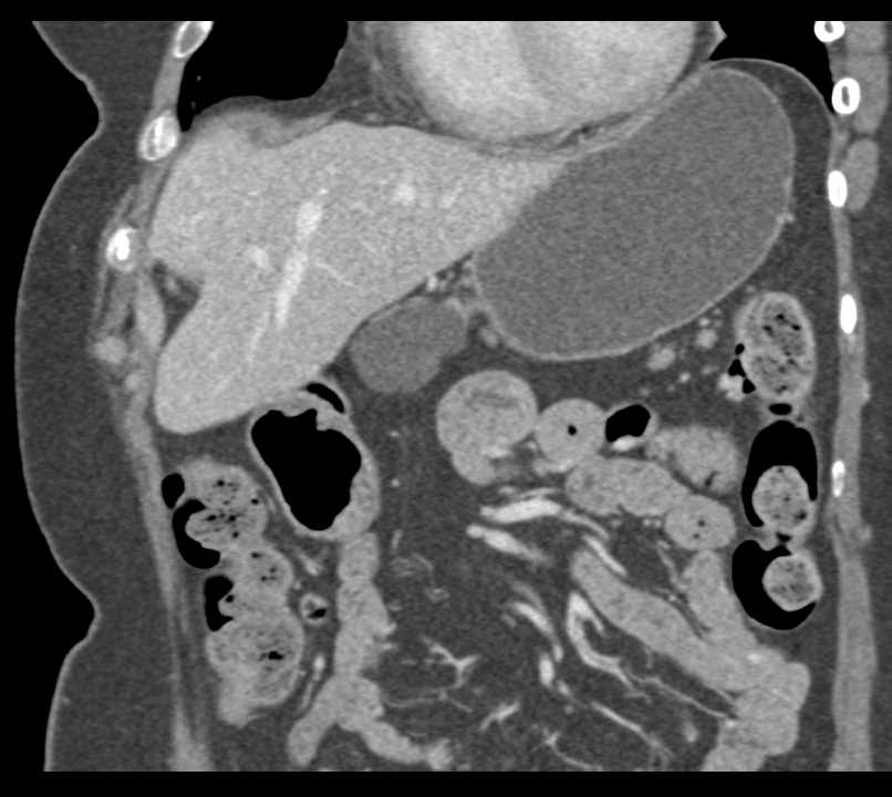 Lymphoepithelial Cyst Pancreas - CTisus CT Scan