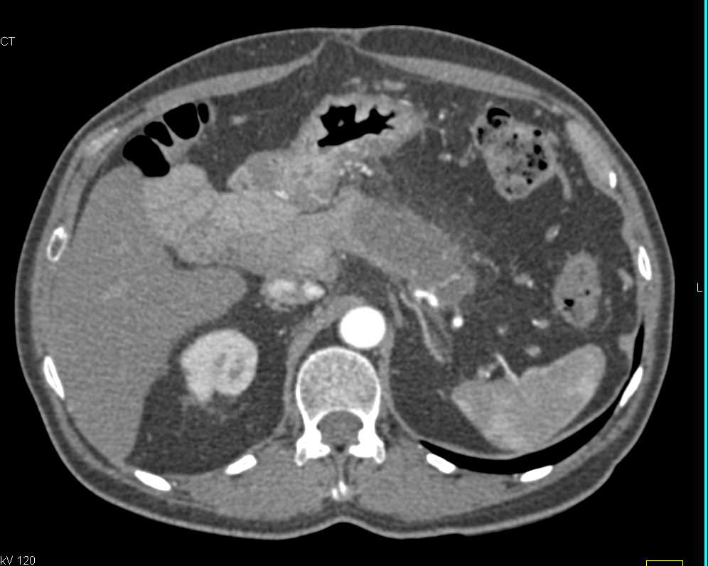 Infiltrating Adenocarcinoma Tail of the Pancreas - CTisus CT Scan