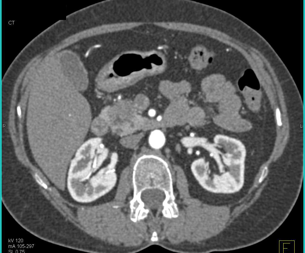 Adenocarcinoma in Head of the Pancreas - CTisus CT Scan