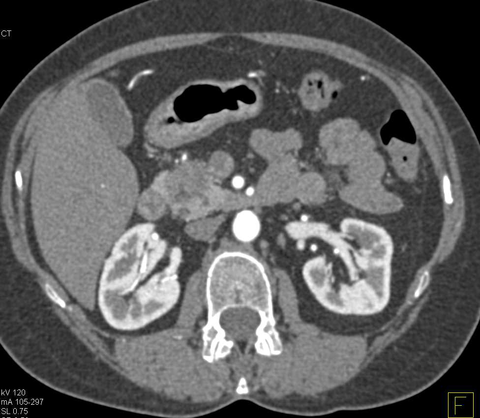 Adenocarcinoma in Head of the Pancreas - CTisus CT Scan