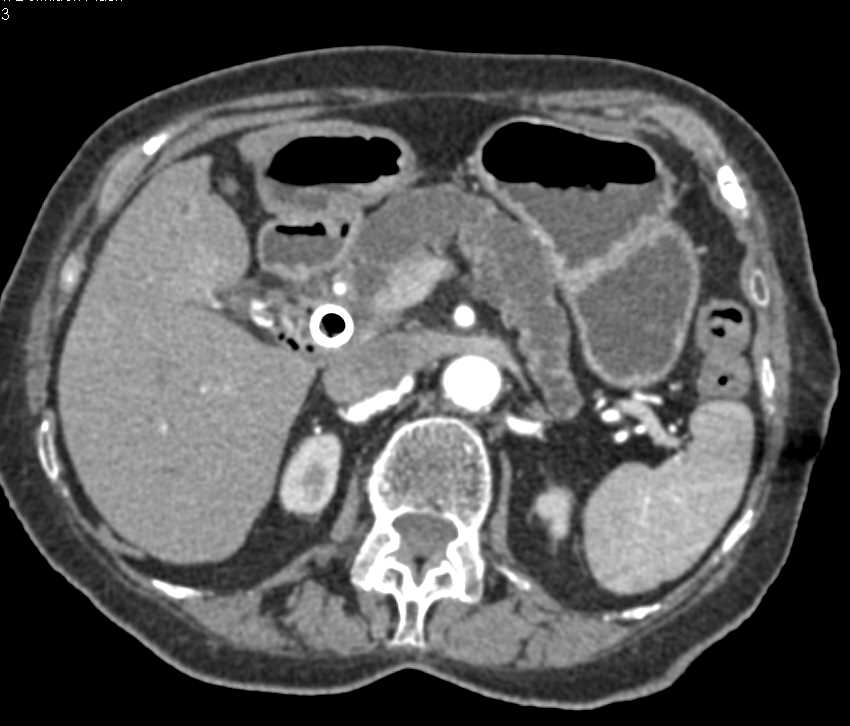 Adenocarcinoma Arises in a Central Intraductal Papillary Mucinous Neoplasm (IPMN) - CTisus CT Scan