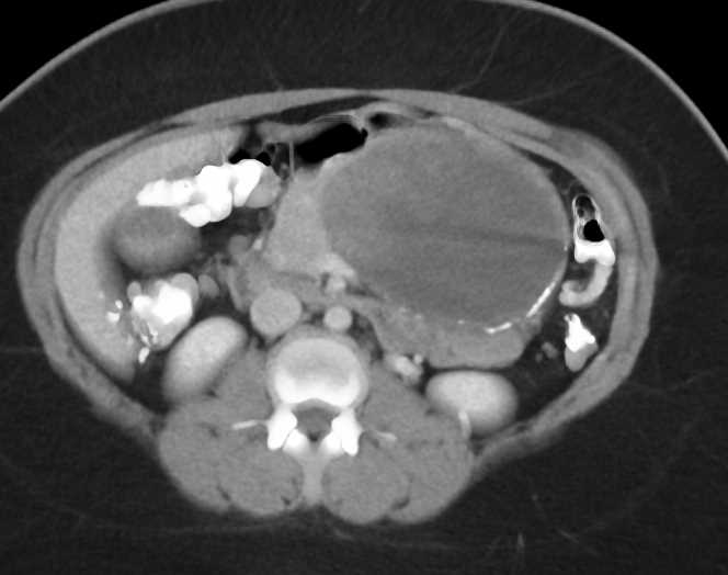 SPEN Tumor Pancreas (Solid and Papillary Epithelial Neoplasm) - CTisus CT Scan