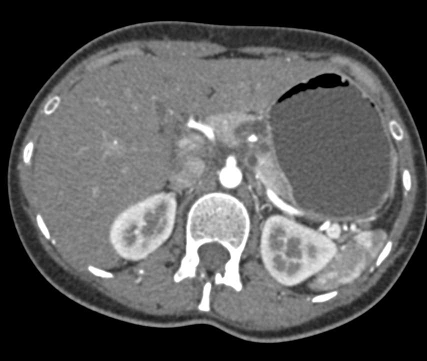 Serous Cystadenoma in Pancreatic Body - CTisus CT Scan