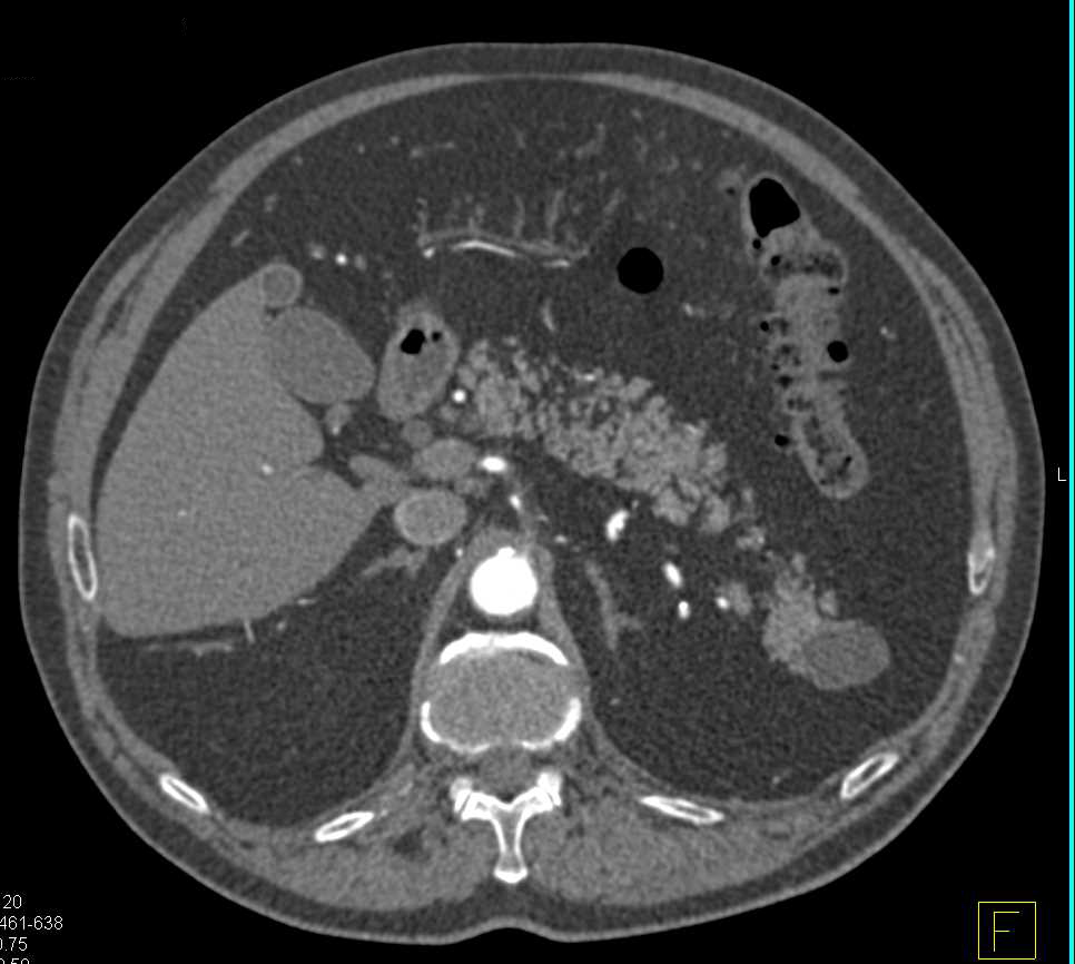 Intraductal Papillary Mucinous Neoplasm (IPMN) Tail of Pancreas - CTisus CT Scan