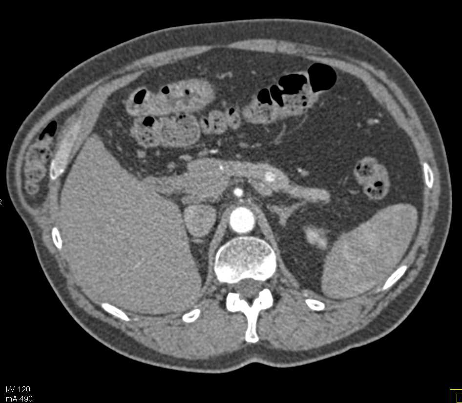 Renal Cell Carcinoma Metastatic to  the Left Prostate Gland and the Pancreas - CTisus CT Scan