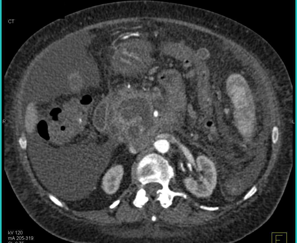 Invasive Pancreatic Cancer - CTisus CT Scan