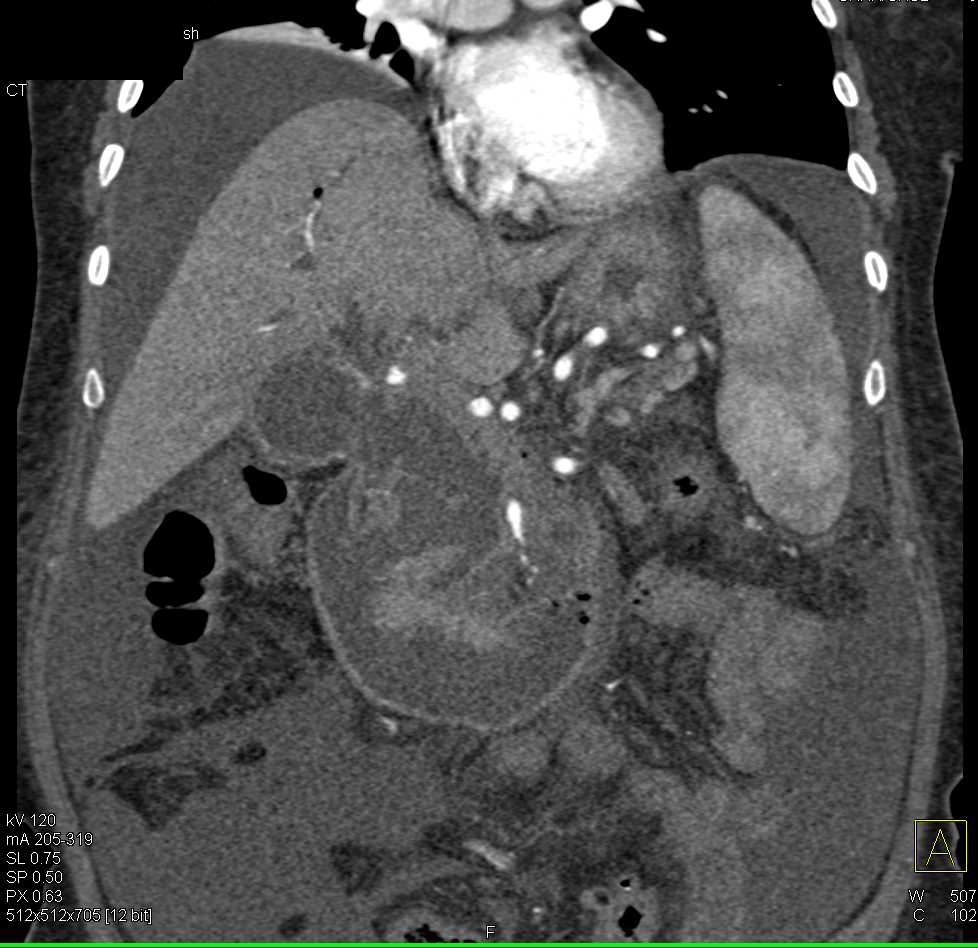 Pancreatic Cancer Invades and Obstructs the Duodenum - CTisus CT Scan