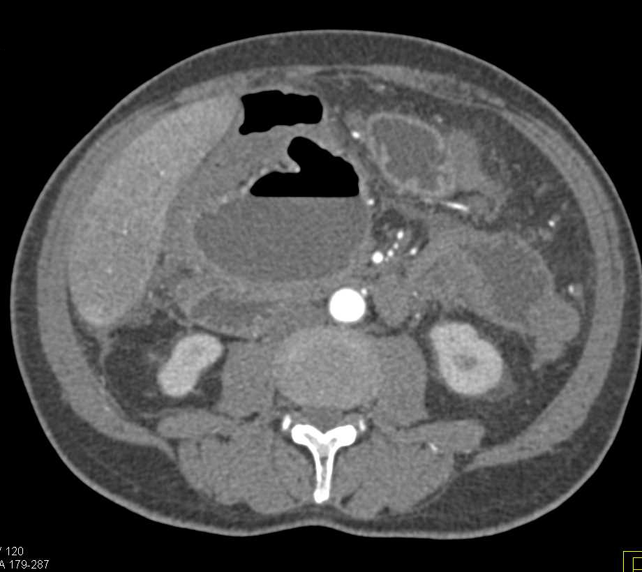 Infected Pancreatic Pseudocyst - CTisus CT Scan