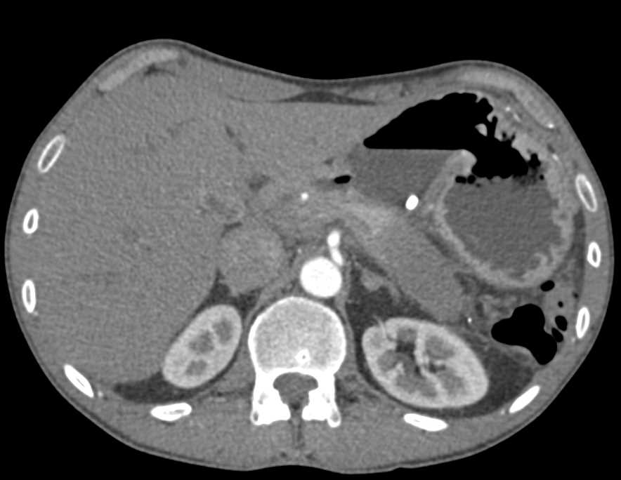 Adenocarcinoma of the Tail of the Pancreas - CTisus CT Scan