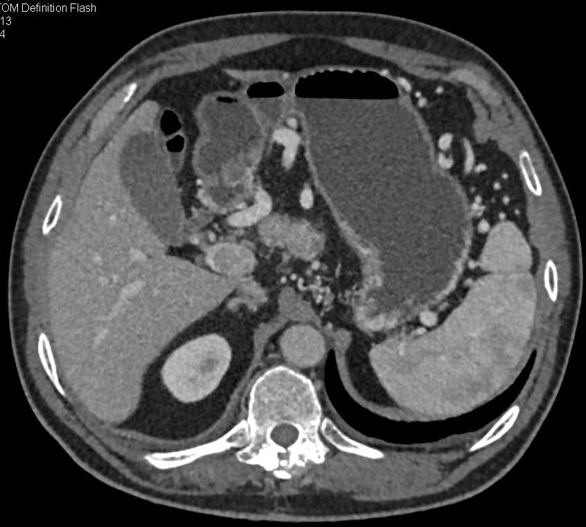 Adenocarcinoma of the Head of the Pancreas Invades the Portal Vein - CTisus CT Scan