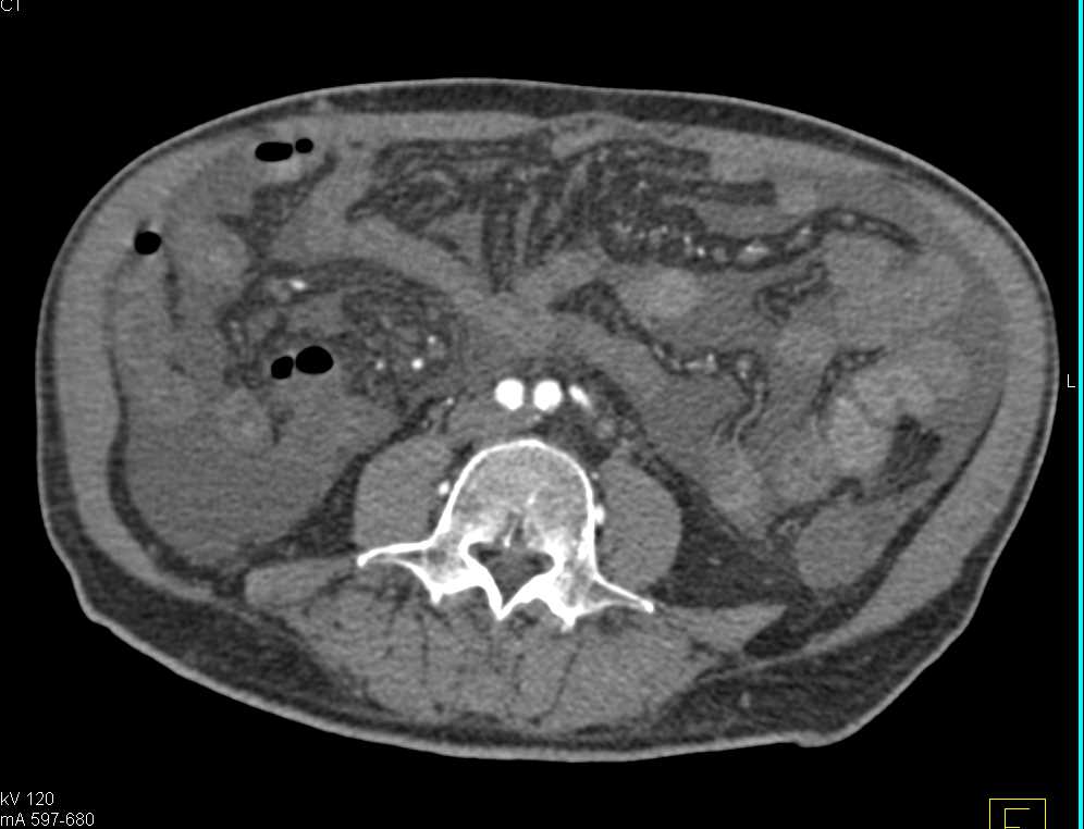 Infected Pseudocyst in the Lesser Sac - CTisus CT Scan