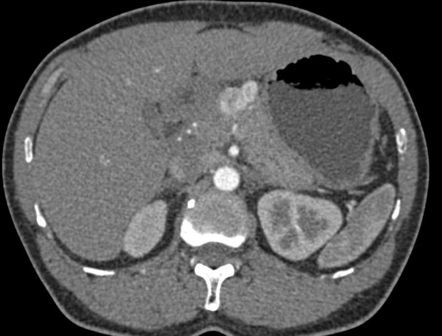 Neuroendocrine Tumor Pancreas - CTisus CT Scan