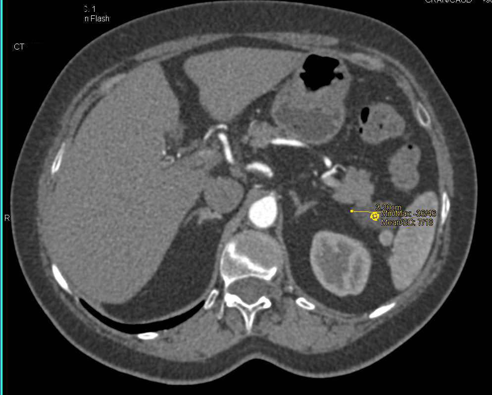 Lymphoepithelial Cyst Tail of Pancreas - CTisus CT Scan