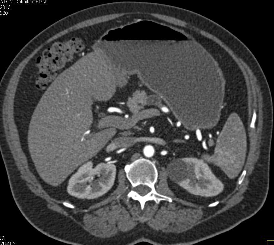 1 cm Neuroendocrine Tumor of the Pancreas Obstructs the Pancreatic Duct - CTisus CT Scan