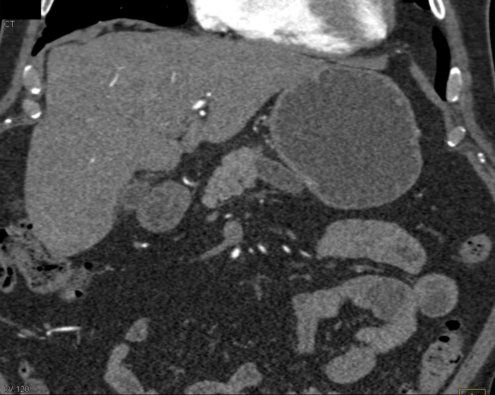 Neuroendocrine Tumor Obstructs the Pancreatic Duct - CTisus CT Scan