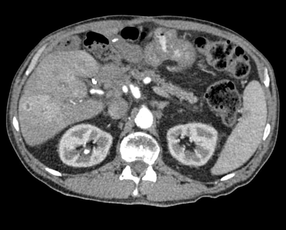 Liver Metastases in a Patient Post Whipple Procedure for Pancreatic Cancer - CTisus CT Scan