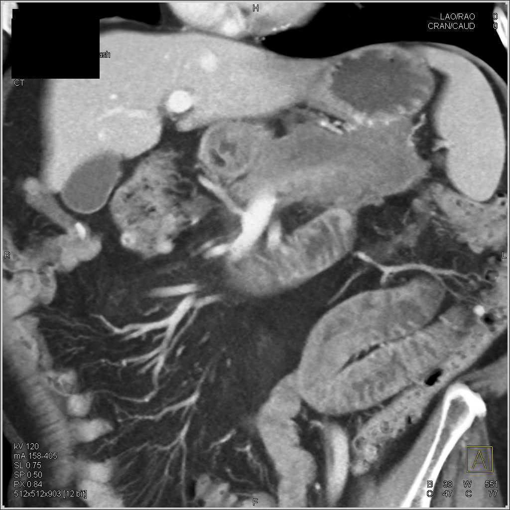 Carcinoma Tail of Pancreas - CTisus CT Scan