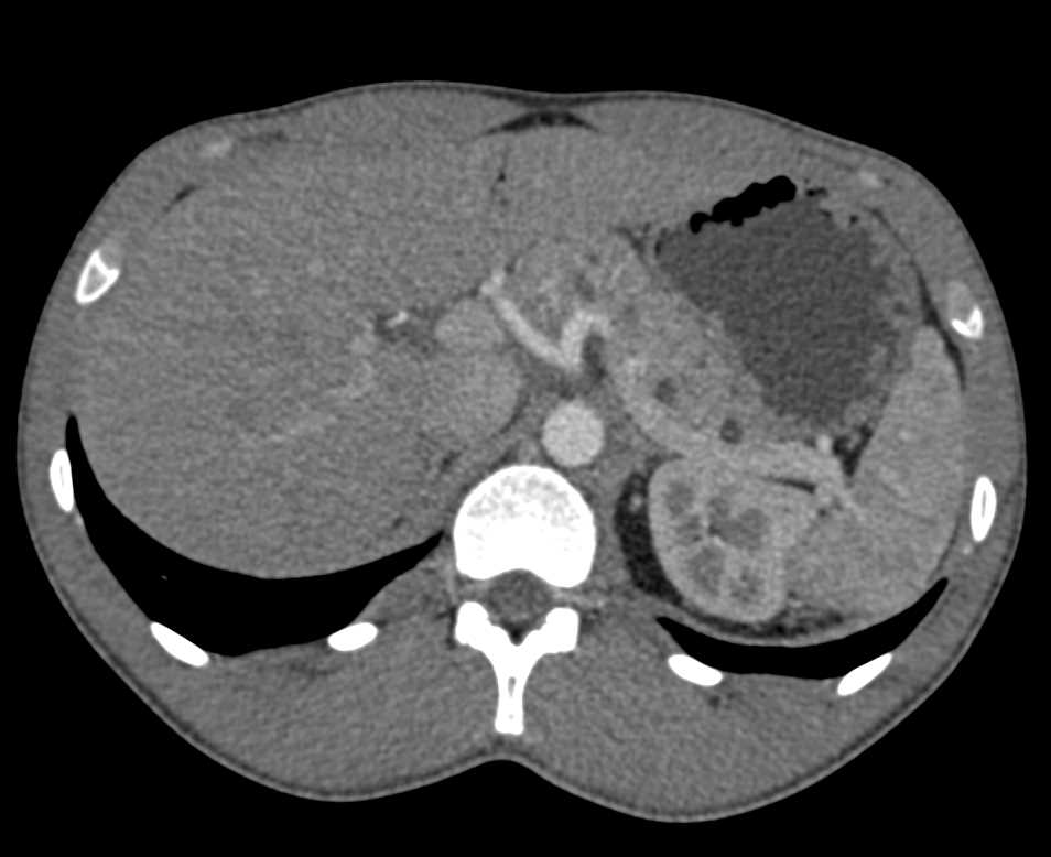 Neuroendocrine Tumor in the head of the Pancreas - CTisus CT Scan