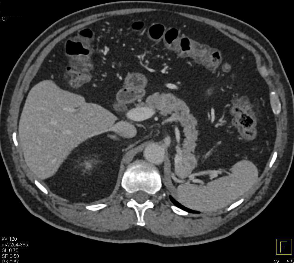 Recurrent Renal Cell Carcinoma to the Tail of the Pancreas - CTisus CT Scan