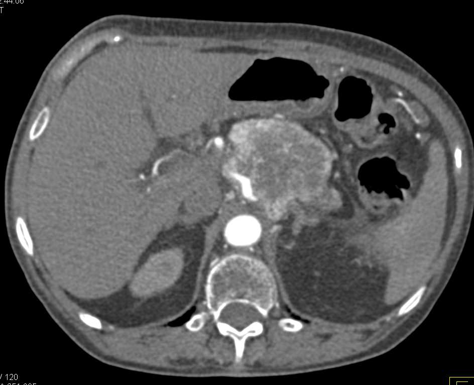 Neuroendocrine Tumor of the Body of the Pancreas with Vascular Encasement - CTisus CT Scan