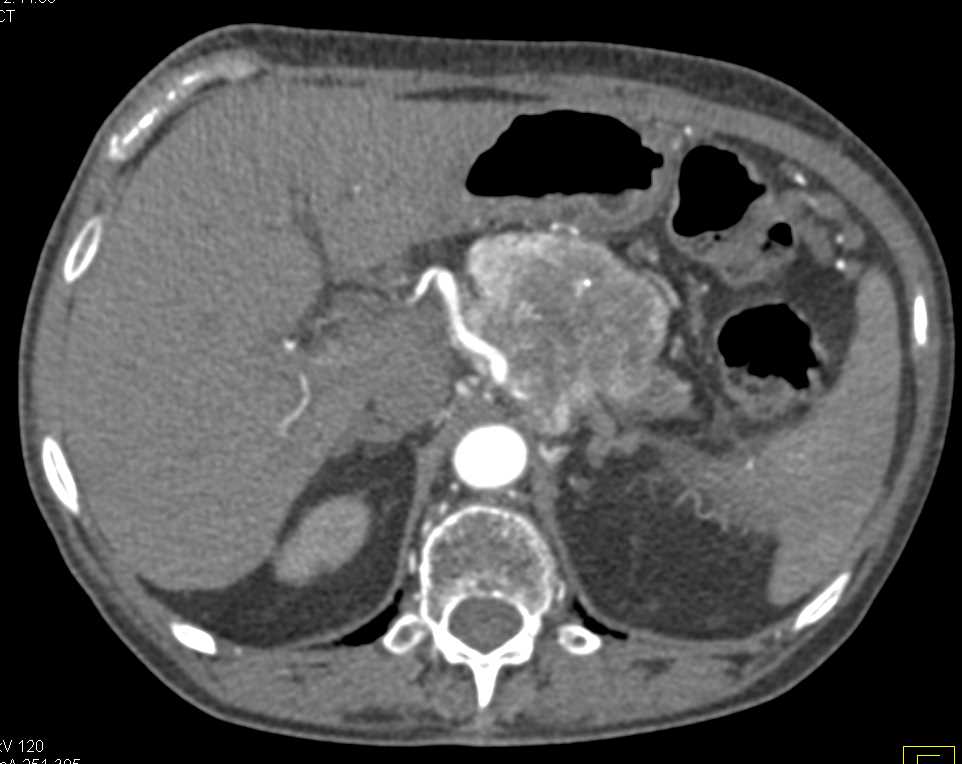 Neuroendocrine Tumor of the Body of the Pancreas with Vascular Encasement - CTisus CT Scan