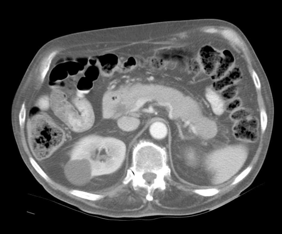 Autoimmune Pancreatitis Pre and Post Steroid Therapy - CTisus CT Scan