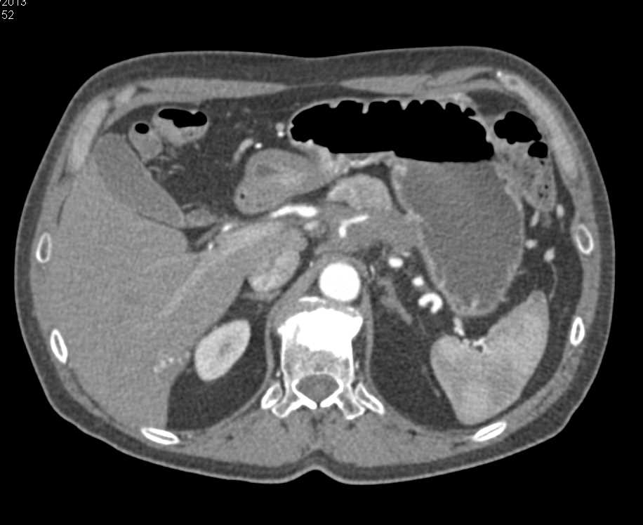 Pancreatic Adenocarcinoma Encases the Common Celiac/Superior Mesenteric Artery (SMA) Trunk - CTisus CT Scan