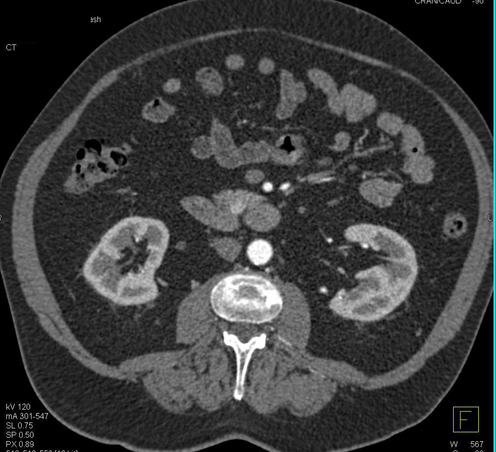 Multiple Neuroendocrine Tumors in the Pancreas in the 1cm Size Range - CTisus CT Scan