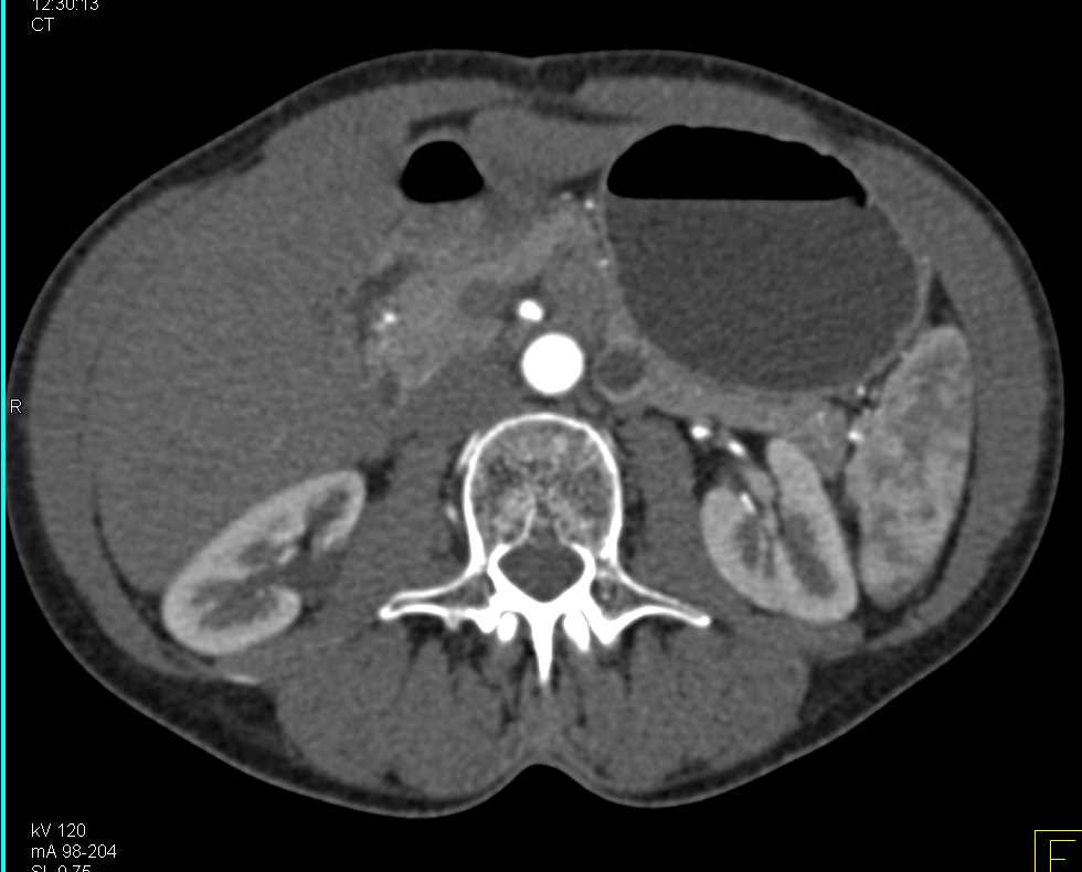 Cystic Neuroendocrine Tumor Pancreas with Enhancing Lesion - CTisus CT Scan