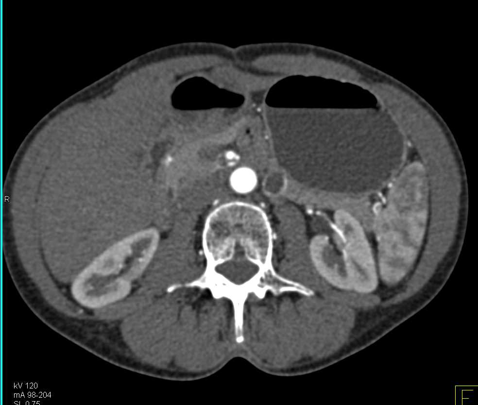 Cystic Neuroendocrine Tumor Pancreas with Enhancing Lesion - CTisus CT Scan